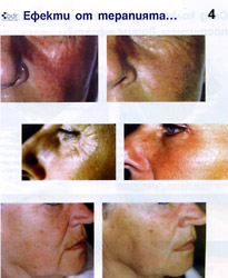 Състоянието на кожата преди и след приложението на метода